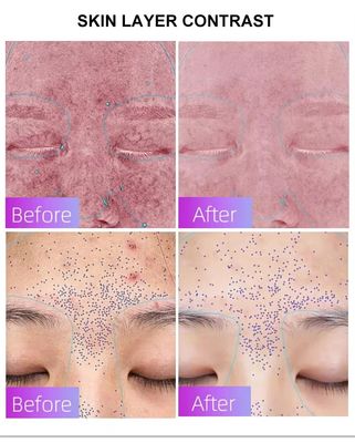 Buy Blue Light Acne Treatment Mask with Intelligent Timer – Manufacturer Direct Supply, Appearance Patent Included online manufacture